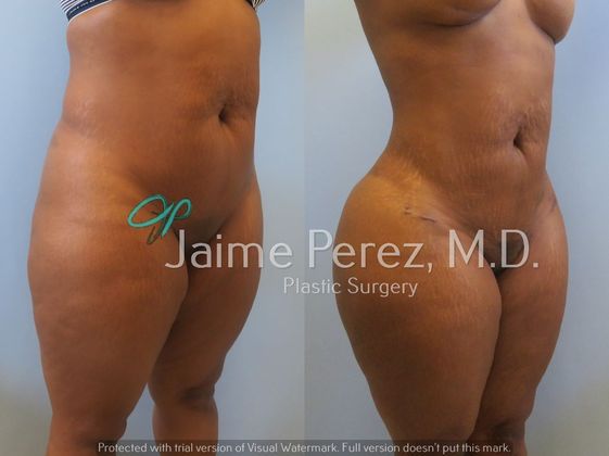 Before & After