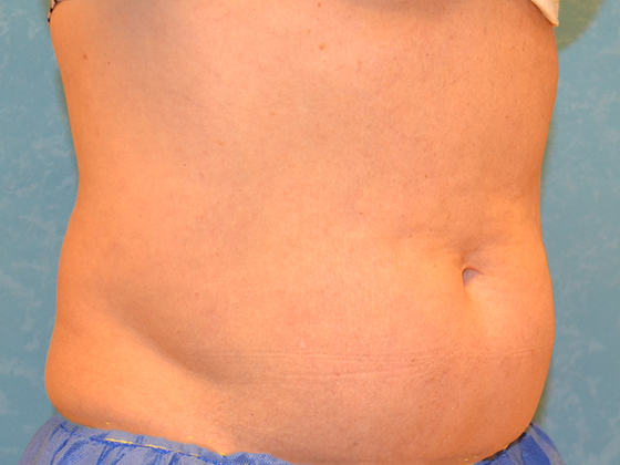 Coolsculpt: Case 1422 Holland, OH - After