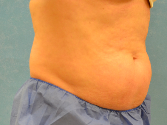 Coolsculpt: Case 1422 Holland, OH - Before