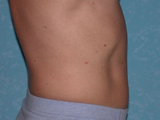 Coolsculpt: Case 1423 Holland, OH - Before