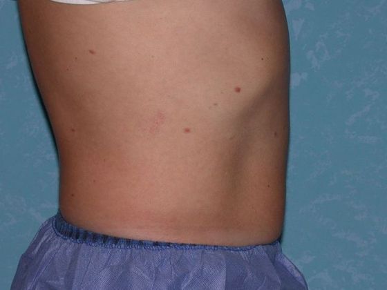 Coolsculpt: Case 1423 Holland, OH - After
