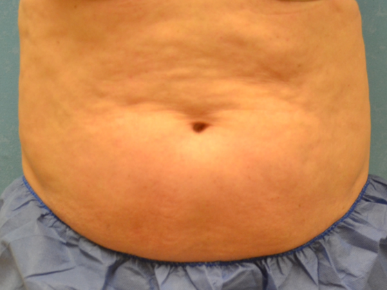 Coolsculpt: Case 1422 Holland, OH - Before