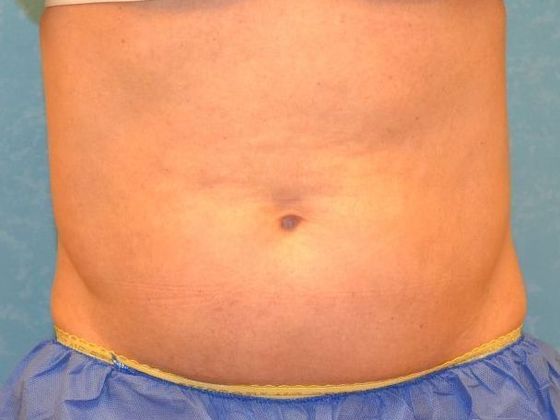 Coolsculpt: Case 1422 Holland, OH - After