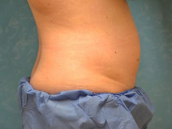 Coolsculpt: Case 1425 Sylvania, OH - Before