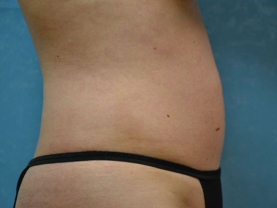 Coolsculpt: Case 1425 Sylvania, OH - After