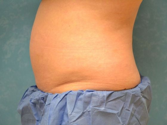 Coolsculpt: Case 1425 Sylvania, OH - Before
