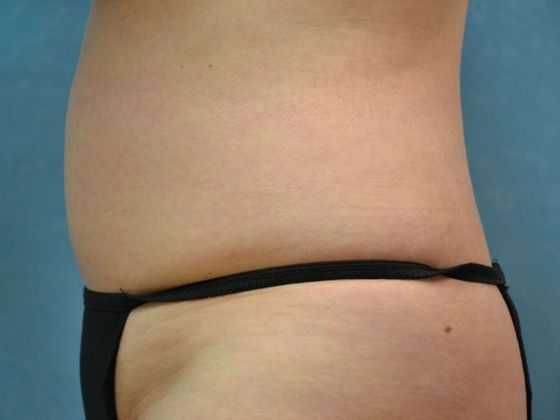 Coolsculpt: Case 1425 Sylvania, OH - After