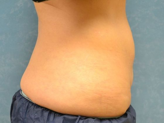 Coolsculpt: Case 1426 Toledo, OH - Before