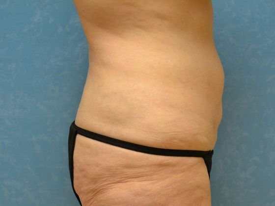 Coolsculpt: Case 1426 Toledo, OH - After