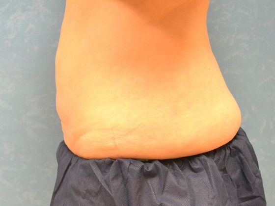 Coolsculpt: Case 1426 Toledo, OH - Before