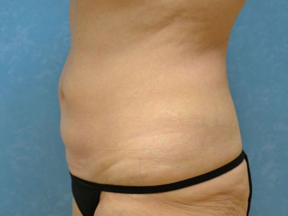 Coolsculpt: Case 1426 Toledo, OH - After