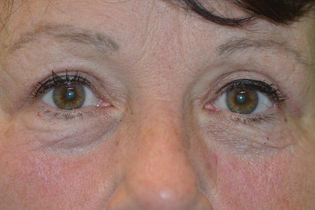 Upper Eyelid Blepharoplasty Cases