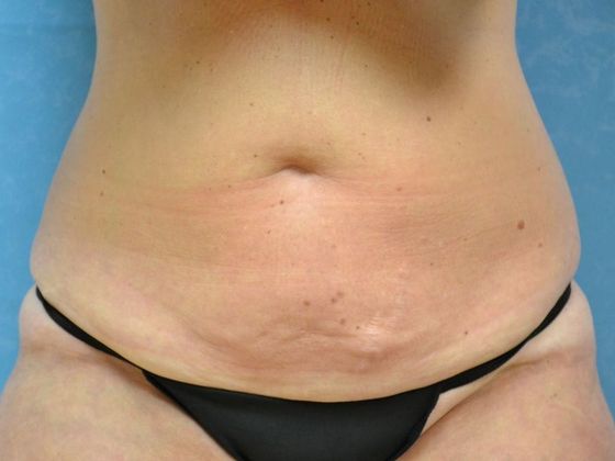 Tummy Tuck Case 1684 Toledo, OH - Before