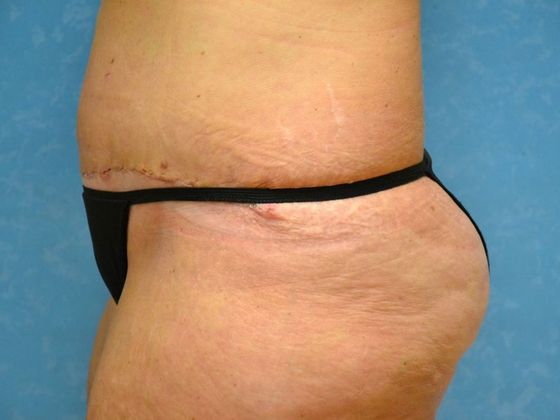 Tummy Tuck: Case 1684 Toledo, OH - After