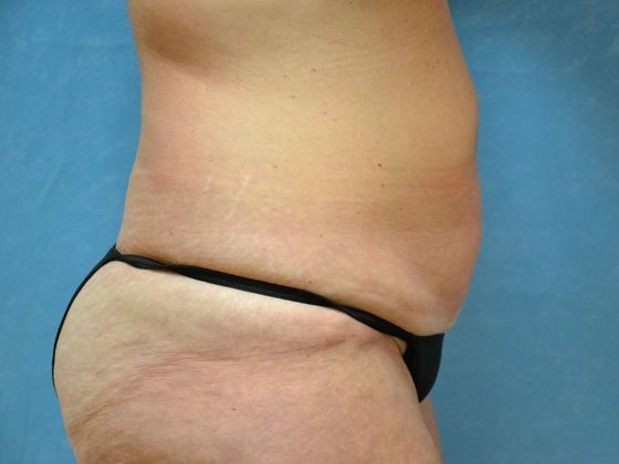 Tummy Tuck: Case 1684 Toledo, OH - Before