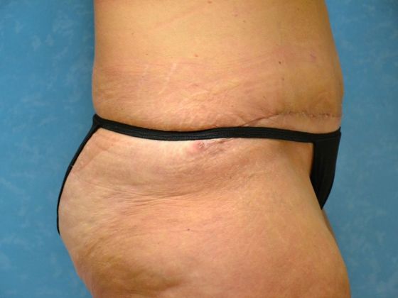Tummy Tuck: Case 1684 Toledo, OH - After