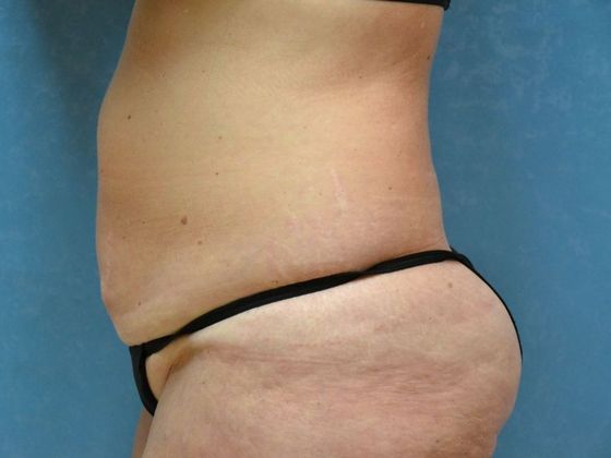 Tummy Tuck: Case 1684 Toledo, OH - Before
