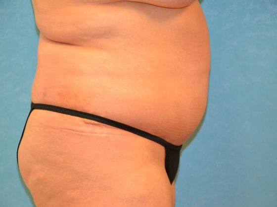 Tummy Tuck: Case 1685 Napoleon, OH - After