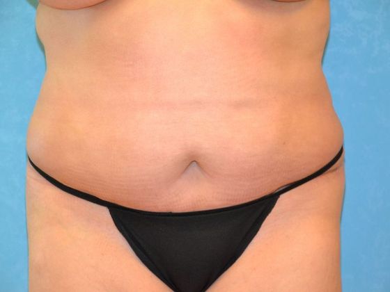 Tummy Tuck Case 1685 Napoleon, OH - After
