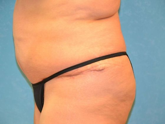 Tummy Tuck: Case 1685 Napoleon, OH - After