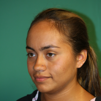 Hairline Lowering Surgery: Case 5 - Before