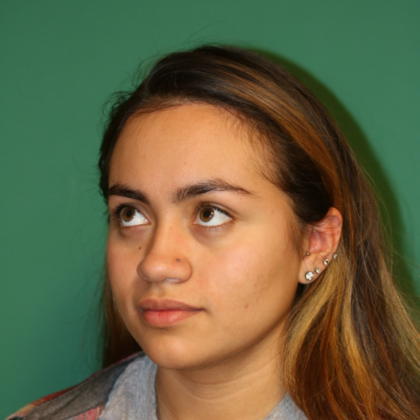 Hairline Lowering Surgery: Case 5 - After