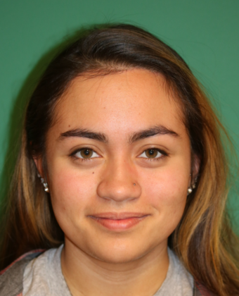 Hairline Lowering Surgery: Case 5 - After