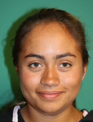 Hairline Lowering Surgery: Case 5 - Before