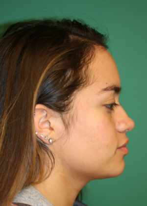 Hairline Lowering Surgery: Case 5 - Before