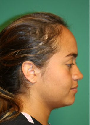 Hairline Lowering Surgery: Case 5 - After