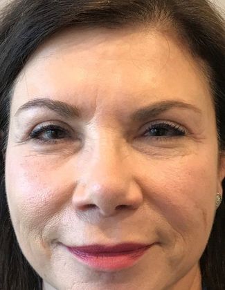 Eyelid Lift: Case 12 - Upper Eyelid Lift and Mini-Brow Lift, Stamford - After