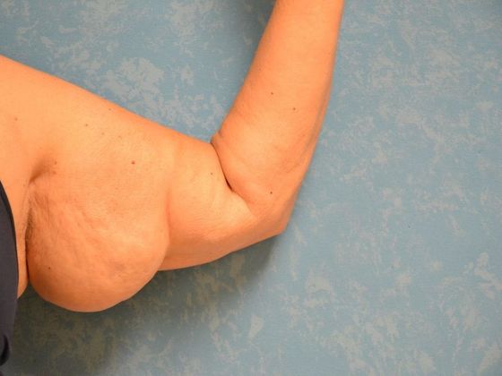 Arm Lift: Case 1424- Weston, OH - After