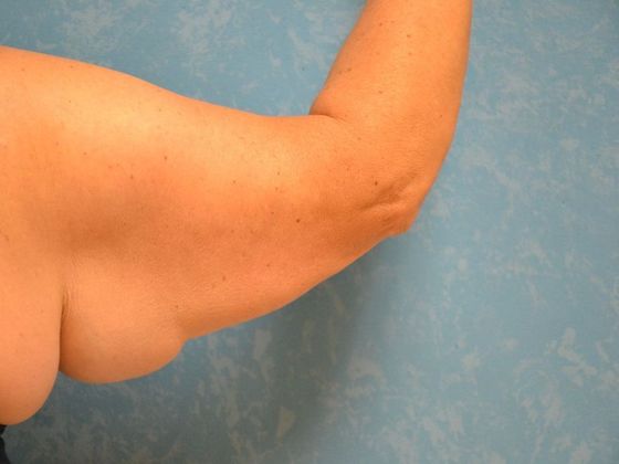 Arm Lift: Case 1424- Weston, OH - Before