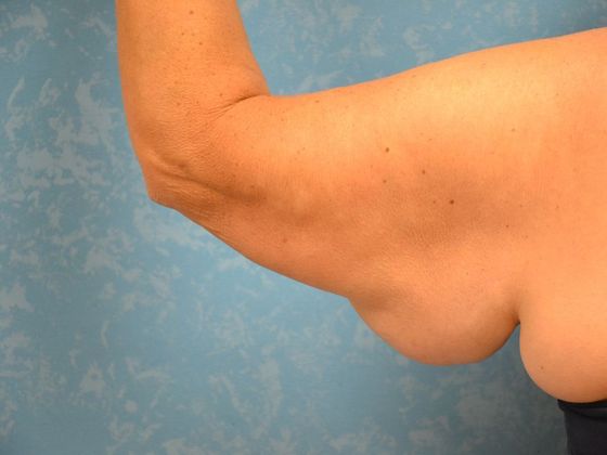 Arm Lift: Case 1424- Weston, OH - Before