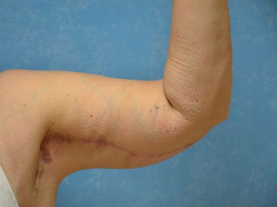 Arm Lift: Case 1424- Weston, OH - Before