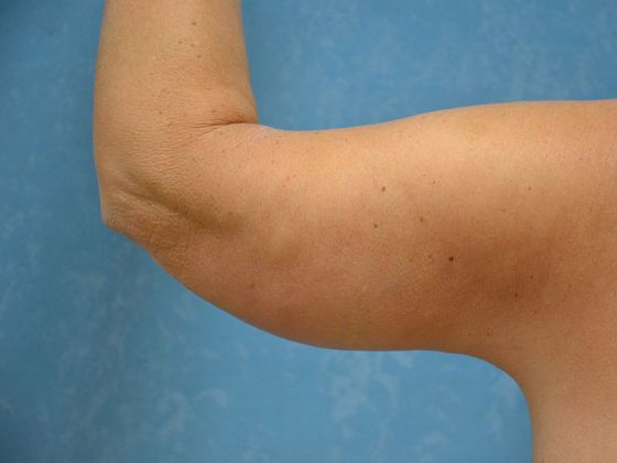 Arm Lift: Case 1424- Weston, OH - After