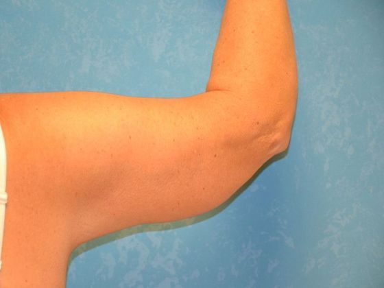 Arm Lift: Case 1424- Weston, OH - After