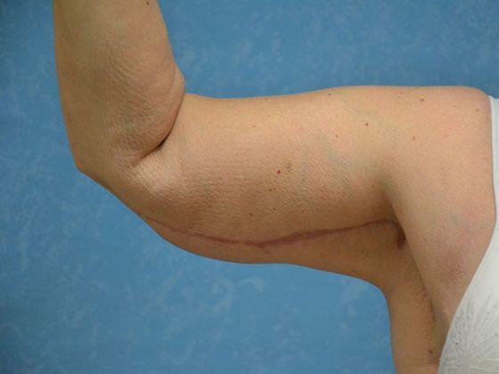 Arm Lift Case 1424- Weston, OH - After