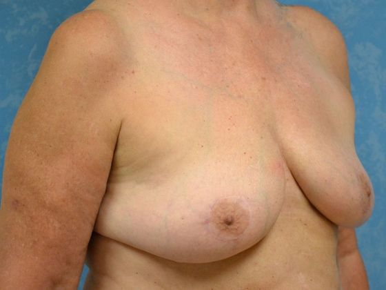 Breast Lift: Case 1425 Gibsonburg, OH - After