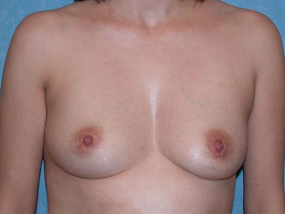 Breast Augmentation BA1312 - Walbridge, OH - Before