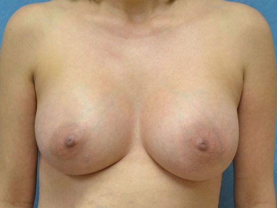 Breast Augmentation BA1312 - Walbridge, OH - After