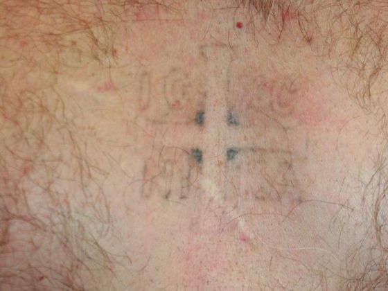 Tattoo Removal : Tattoo Removal 8 - After