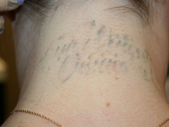 Tattoo Removal : Tattoo Removal 9 - After