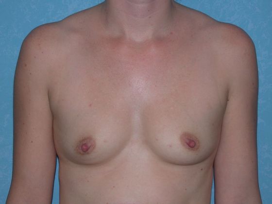 Breast Augmentation BA1316 - Bowling Green, OH - Before