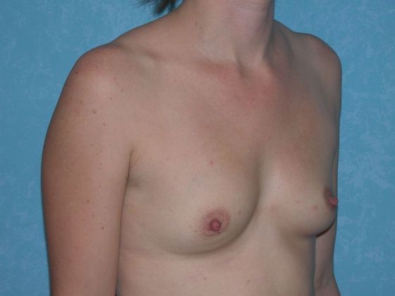 Breast Augmentation: BA1316 - Bowling Green, OH - Before