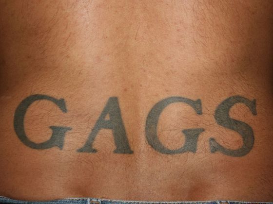 Tattoo Removal : Tattoo Removal 10 - Before