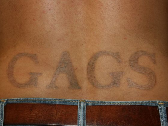 Tattoo Removal : Tattoo Removal 10 - After