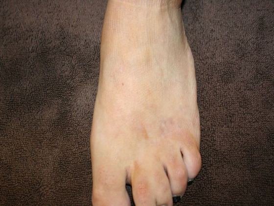 Tattoo Removal : Tattoo Removal 2 - After