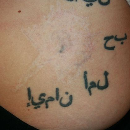 Tattoo Removal : Tattoo Removal 11 - After