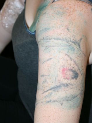 Tattoo Removal : Tattoo Removal 7 - After
